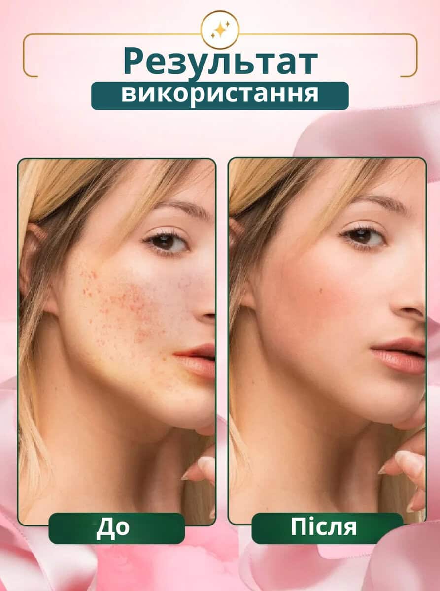 Патчі від акне гідроколоїдні 72 шт